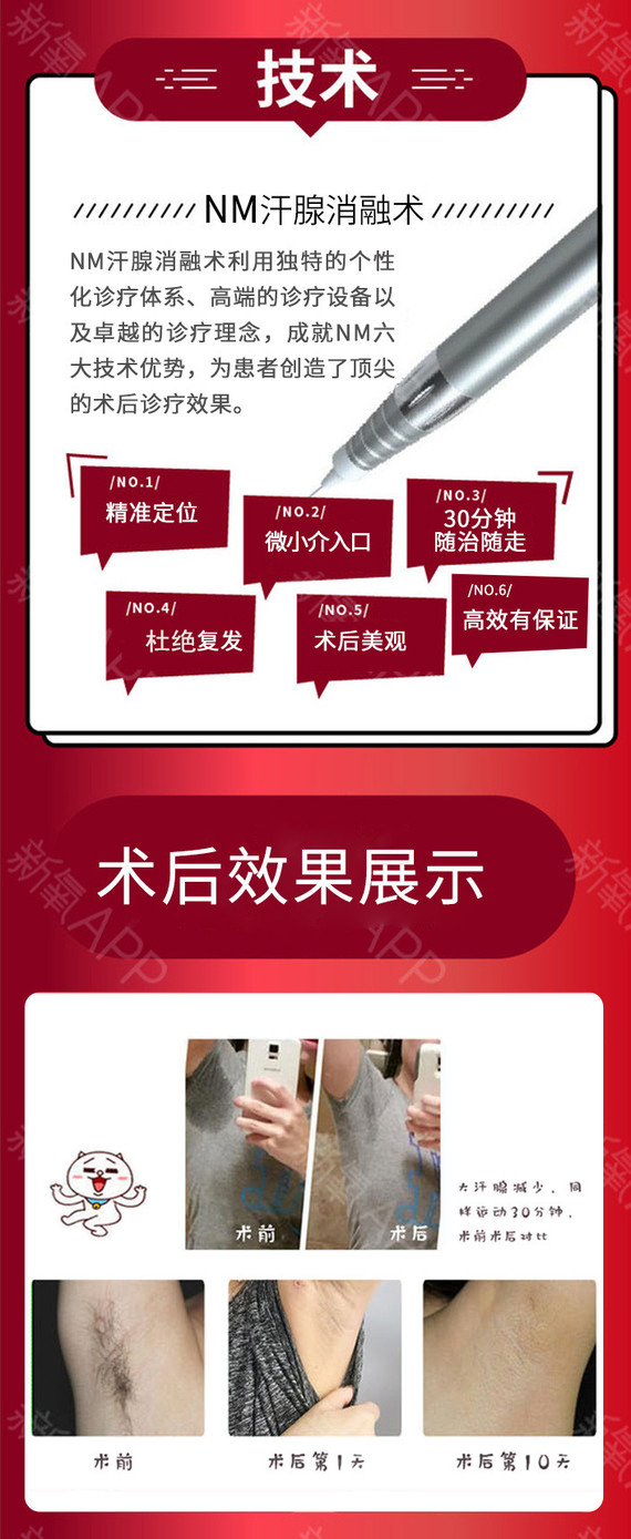 南京腋臭科技革新重塑清新生活，最新治疗技术揭秘